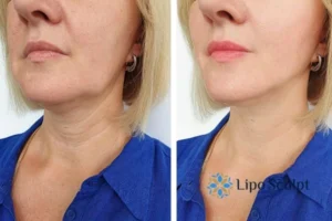 Double chin before and after Hi-Fu treatment 4 Book your double chin treatment Maplehurst today! We are here to help!