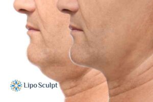 Double chin before and after Hi-Fu treatment 2 Double chin treatment Maplehurst from Lipo Sculpt - feel more confident today!