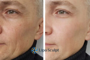 How to Fight Aging Symptoms 3 Fight Aging Symptoms Maplehurst With HIFU and Morpheus8 Today!