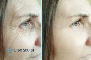 How to Fight Aging Symptoms 2 Do you want to Fight Aging Symptoms Maplehurst? Contact Lipo Sculpt today!